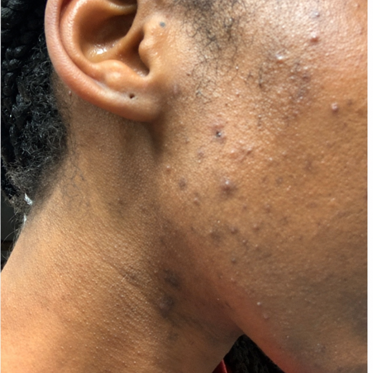 Before using the Bolden Clear Skin Kit — customer 2