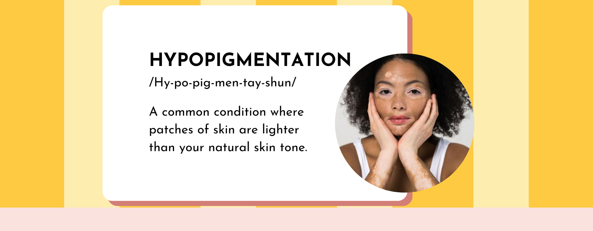 Beauty Beyond Color: Understanding and Addressing Hypopigmentation