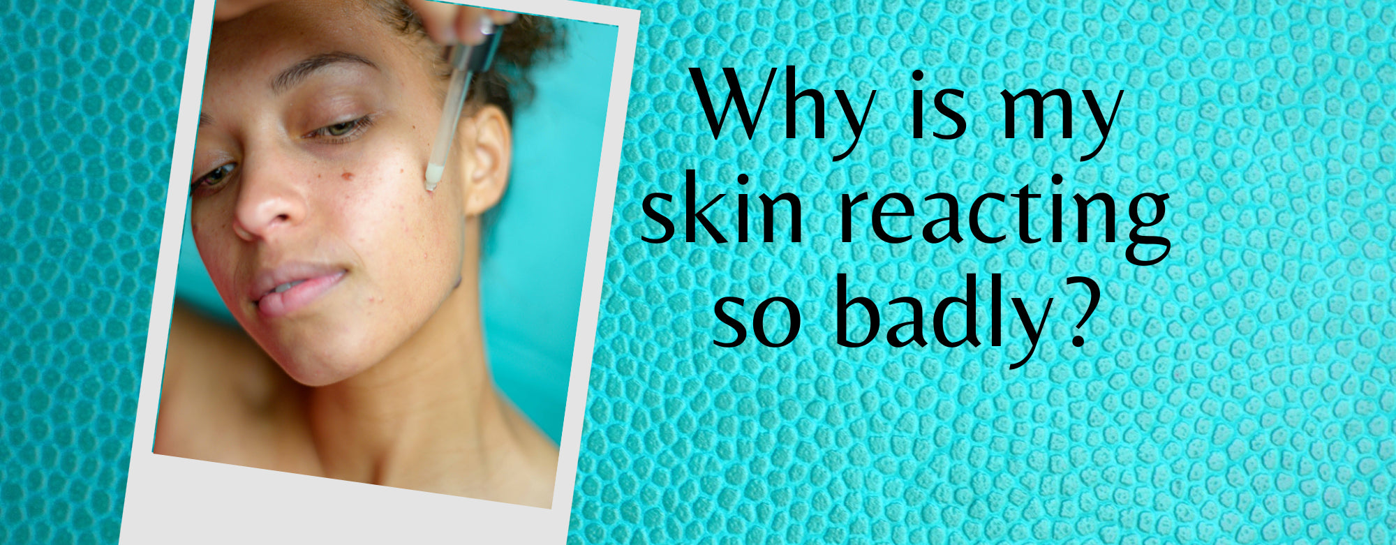 How to Tell if Your Skin is Purging