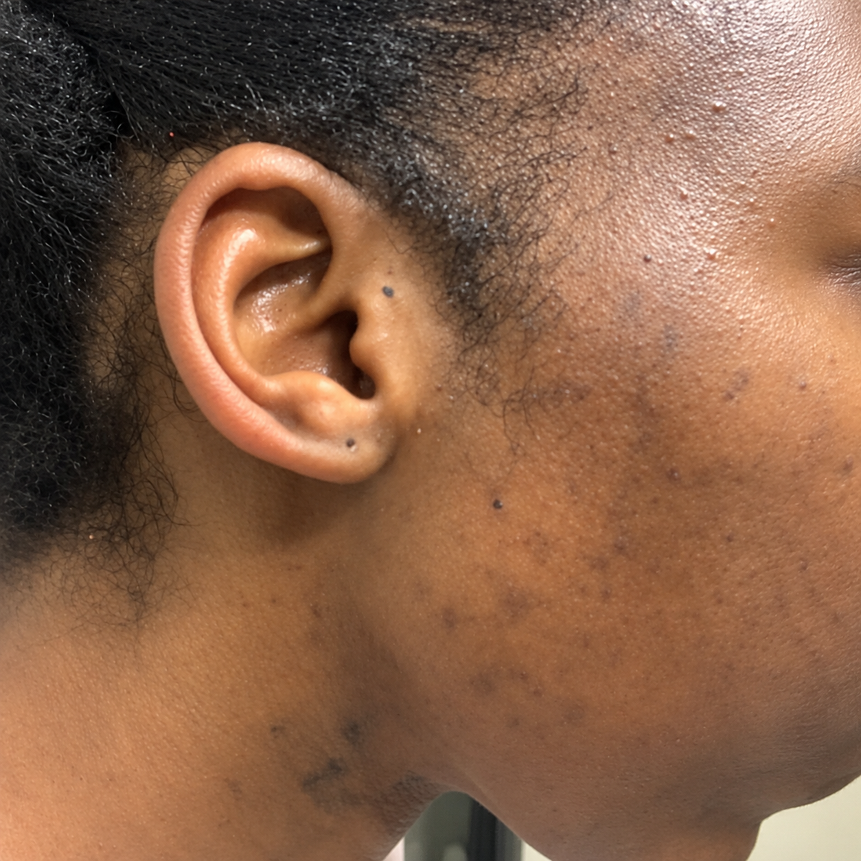 After using the Bolden Clear Skin Kit — customer 2