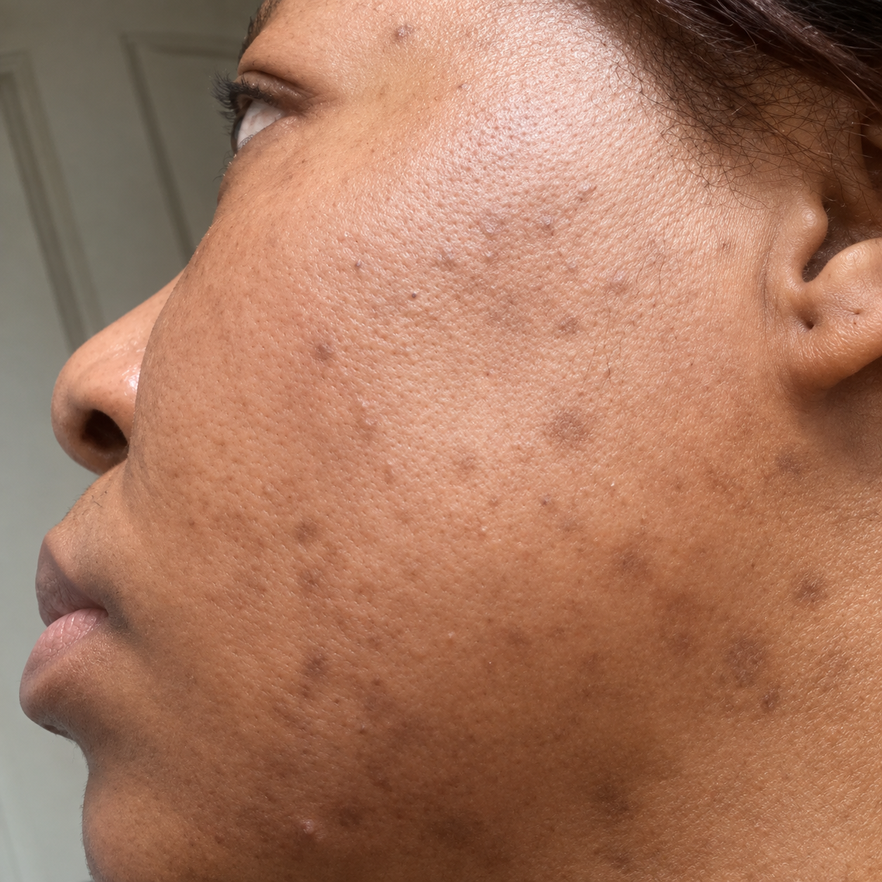 After — week 3, same cheek close-up